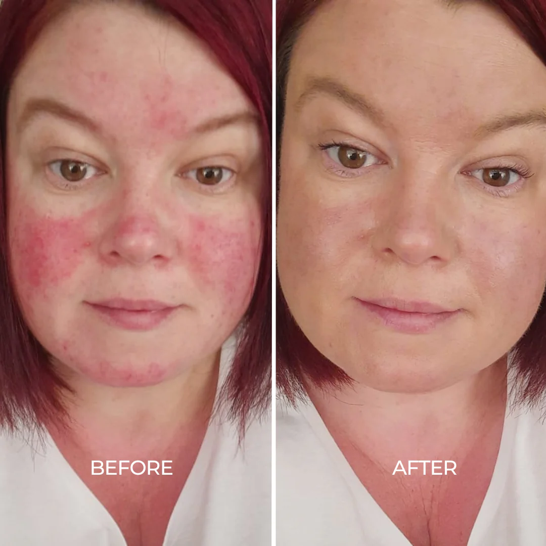 Rosacea Care Kit - Image 4